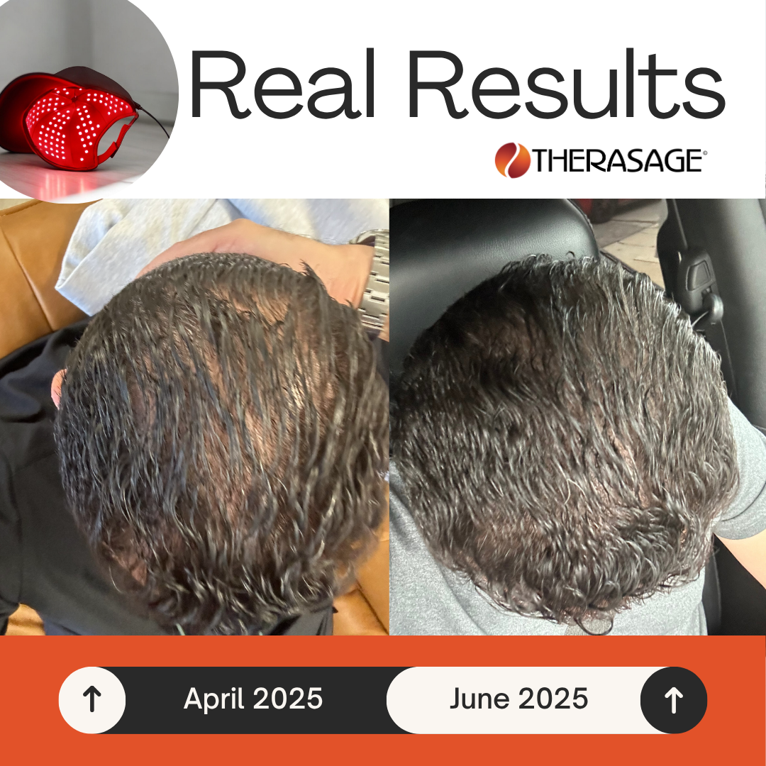 Before and after photos of a scalp from TheraCap use