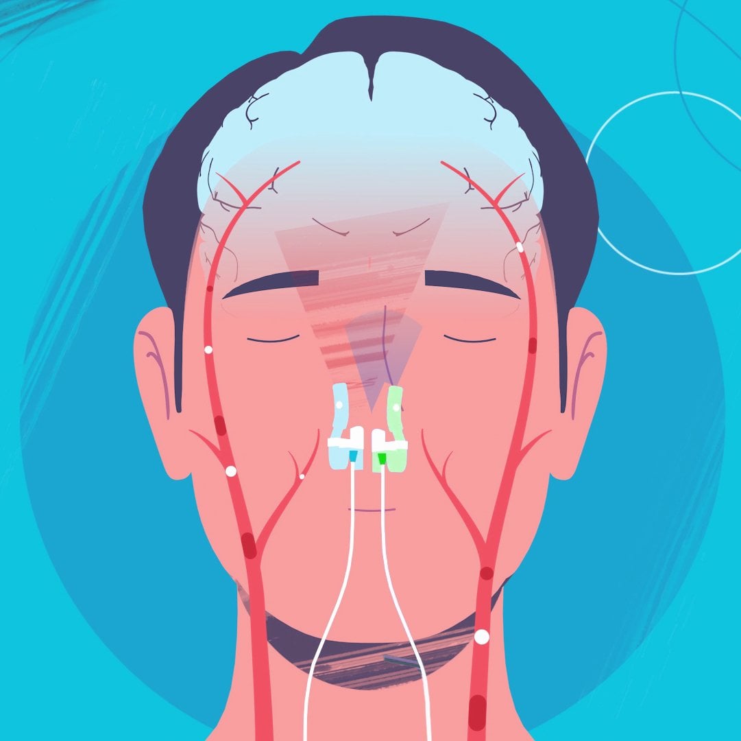 Illustration of the Vielight MIP intranasal light path #Configuration_MIP 633-810